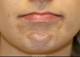 BTx Anti-wrinkle & Hyperhydrosis Treatment