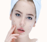 Acne Recovery Peel
