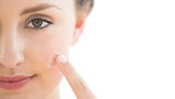 Acne Recovery Peel