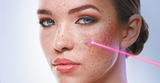 StarWalker Hybrid Laser - Skin Whitening