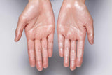 BTx Anti-wrinkle & Hyperhydrosis Treatment